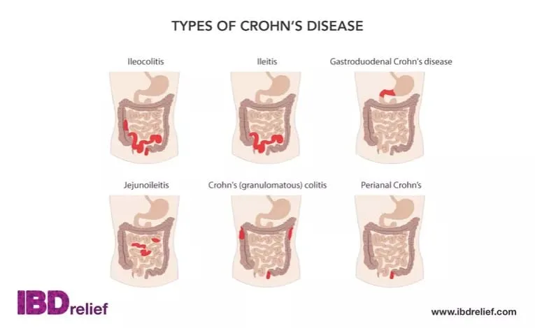 Bệnh viêm ruột Crohn có 6 loại phụ thuộc vào vị trí xuất hiện trong ống tiêu hóa. (Nguồn: IBDrelief)