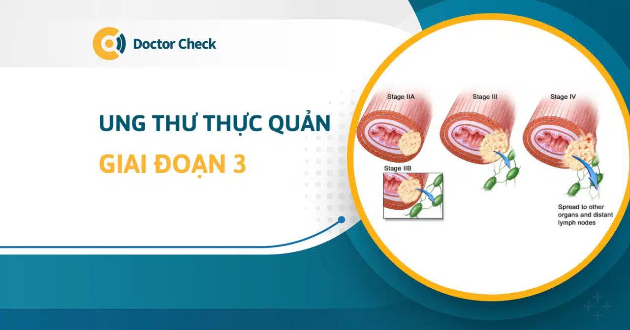 ung thư thực quản giai đoạn 3