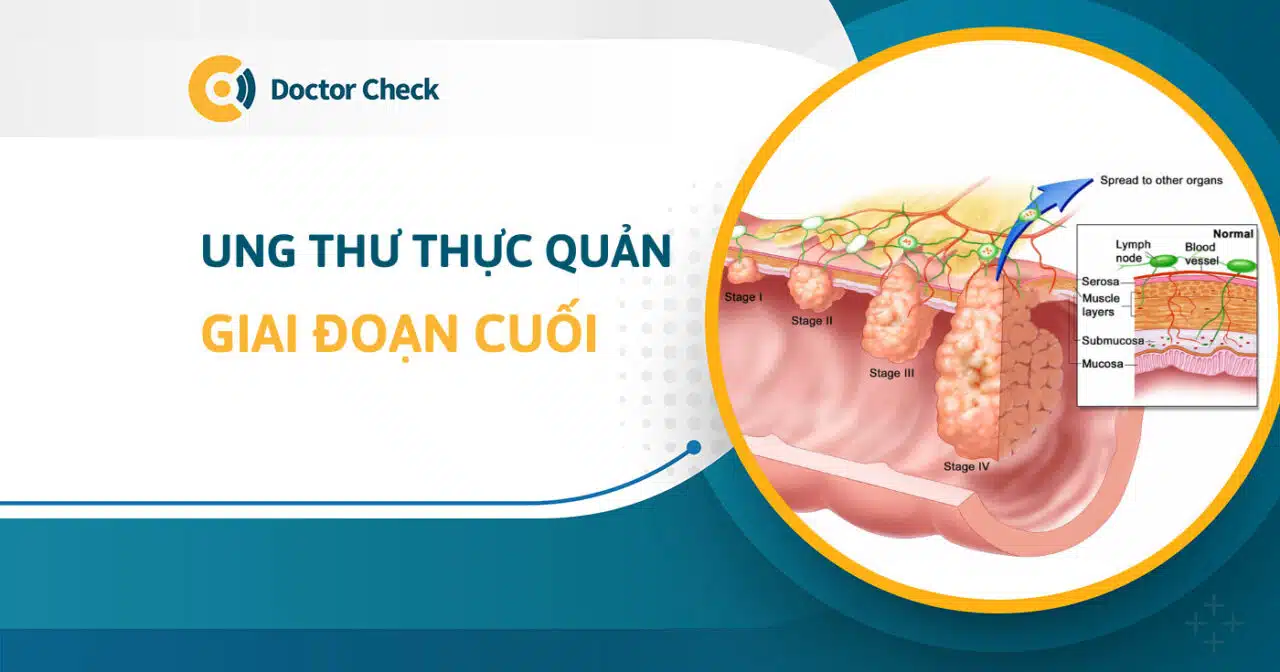 Ung thư thực quản giai đoạn cuối