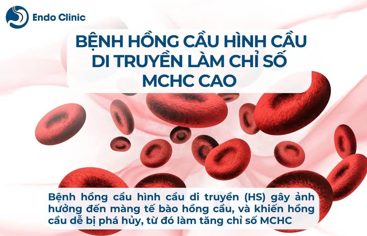 Bệnh hồng huyết cầu hình cầu DT thực hiện chỉ số MCHC vô xét nghiệm ngày tiết tăng cao