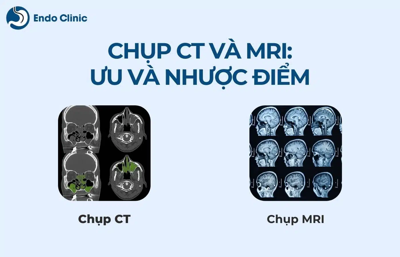 Chụp CT và MRI: Ưu và nhược điểm